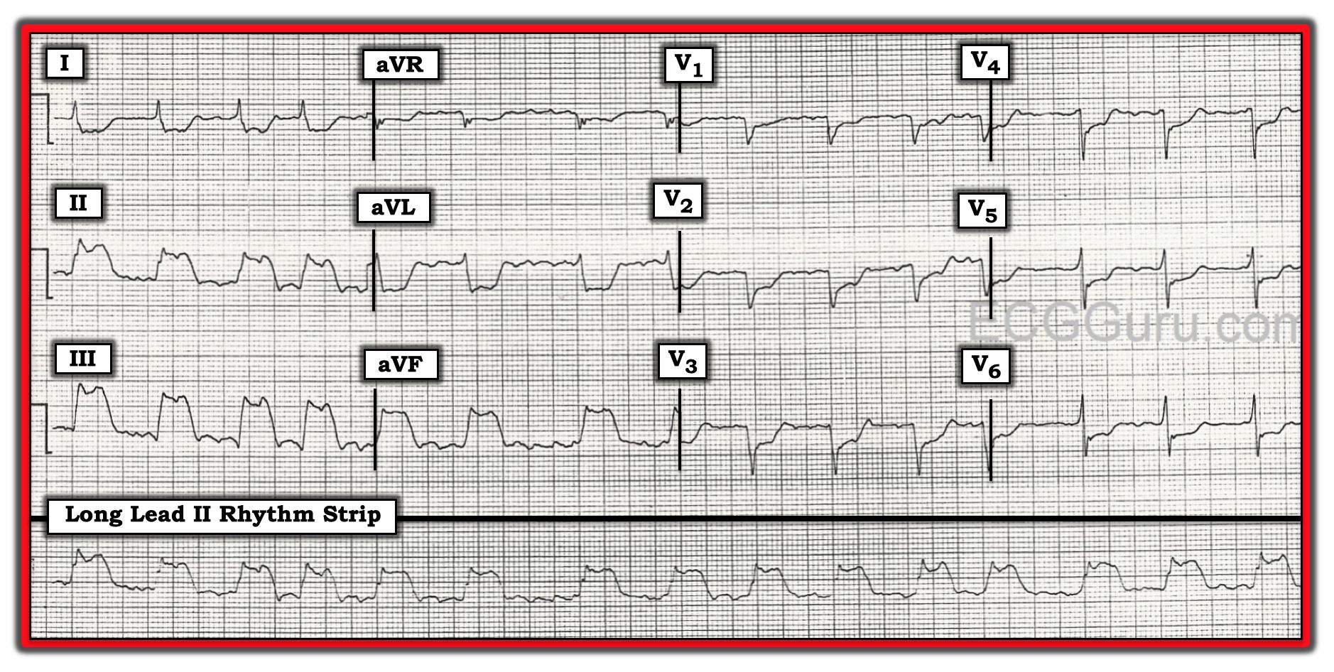 Inferior Wall M I Ecg Guru Instructor Resources